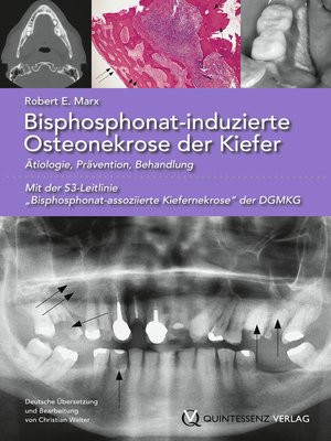 cover image of Bisphosphonat-induzierte Osteonekrose der Kiefer